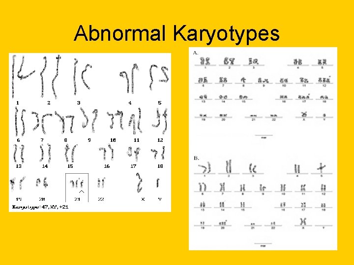 Abnormal Karyotypes Abnormal Karyotypes