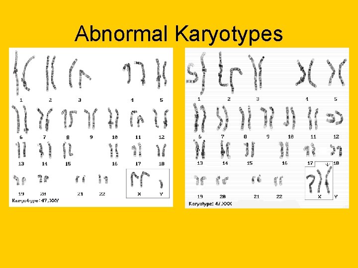 Abnormal Karyotypes Abnormal Karyotypes