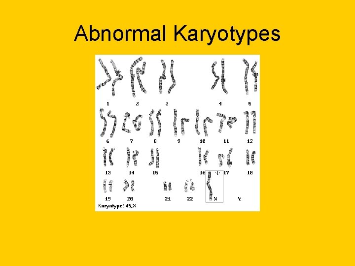 Abnormal Karyotypes Abnormal Karyotypes