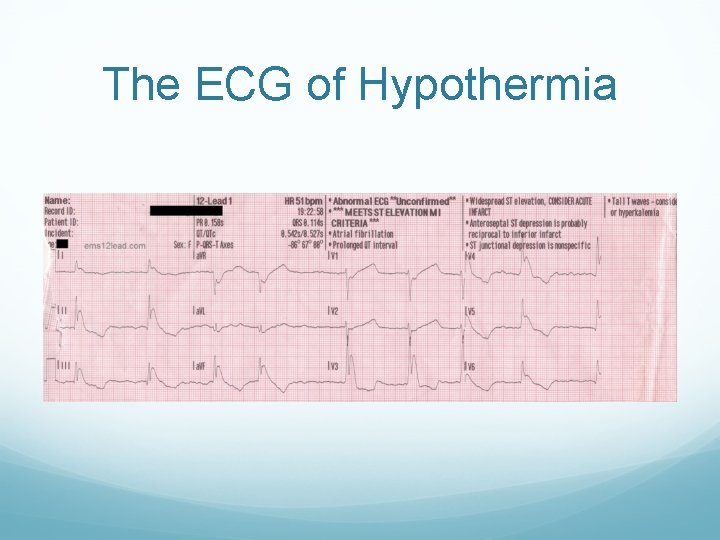 The ECG of Hypothermia 
