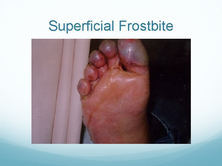 Superficial Frostbite 
