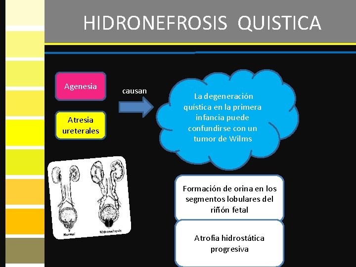 HIDRONEFROSIS QUISTICA Agenesia Atresia ureterales causan La degeneración Degeneración quística en la aprimera que