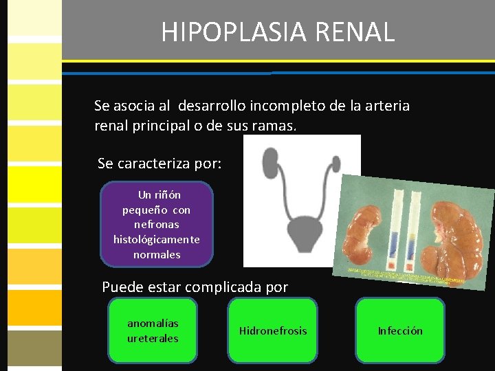 HIPOPLASIA RENAL Se asocia al desarrollo incompleto de la arteria renal principal o de