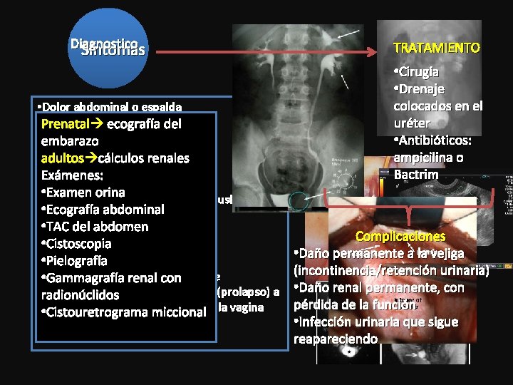 Diagnostico Síntomas • Dolor abdominal o espalda • Prenatal Hematuria ecografía del • embarazo