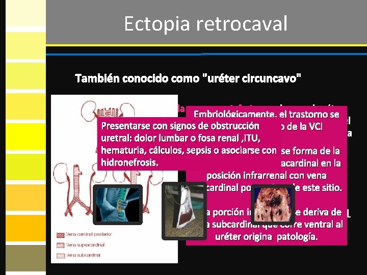 Ectopia retrocaval También conocido como "uréter circuncavo" Anomalía de desarrollo de la vena cava