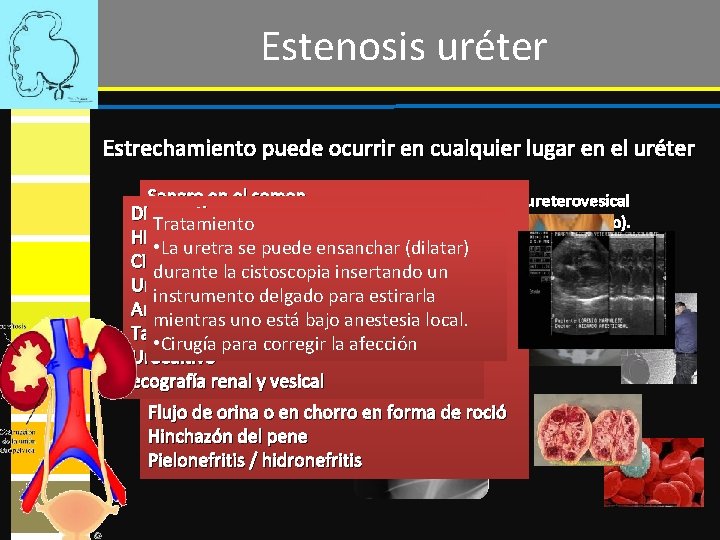 Estenosis uréter Estrechamiento puede ocurrir en cualquier lugar en el uréter Sangre en el