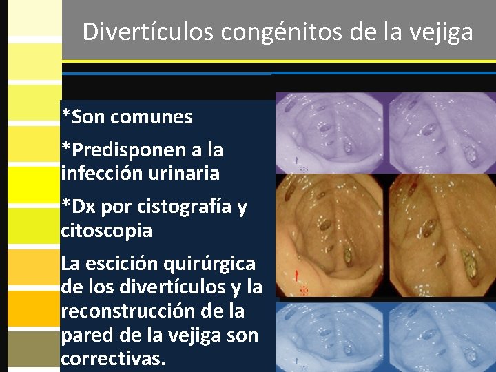 Divertículos congénitos de la vejiga *Son comunes *Predisponen a la infección urinaria *Dx por