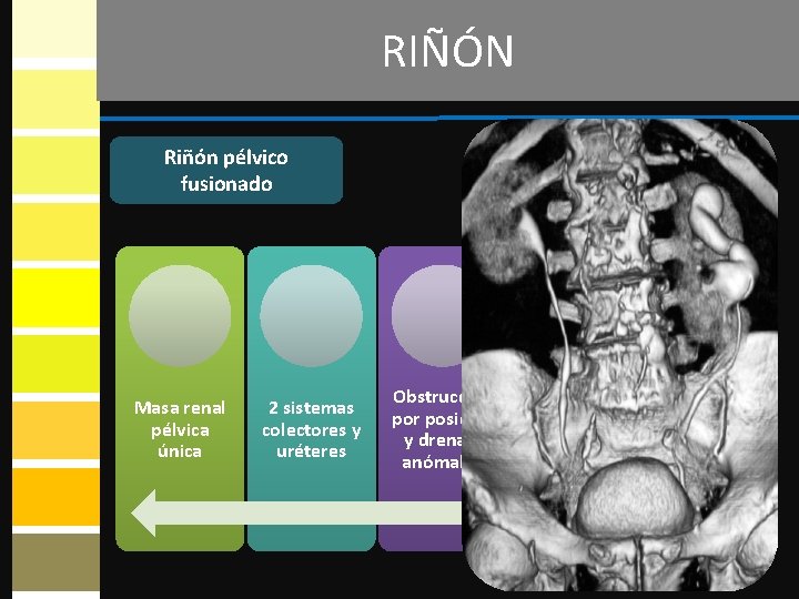 RIÑÓN Riñón pélvico fusionado Masa renal pélvica única 2 sistemas colectores y uréteres Obstrucción