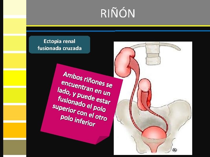 RIÑÓN Ectopia renal fusionada cruzada Ambo s riño nes se encue ntran lado, y