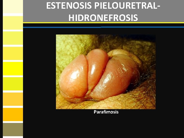 ESTENOSIS PIELOURETRALHIDRONEFROSIS Parafimosis 