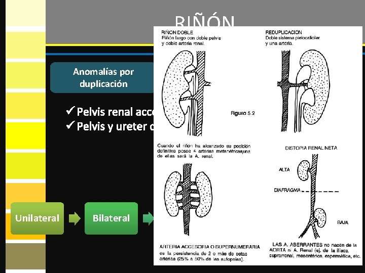 RIÑÓN Anomalías por duplicación ü Pelvis renal accesoria ü Pelvis y ureter dobles Unilateral