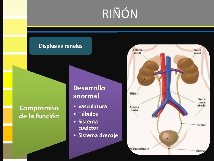 RIÑÓN Displasias renales Desarrollo anormal Compromiso de la función • vasculatura • Túbulos •
