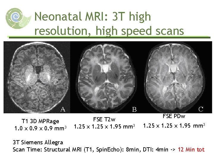 Neonatal MRI: 3 T high resolution, high speed scans T 1 3 D MPRage