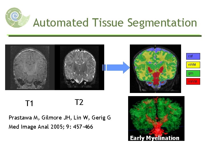 Automated Tissue Segmentation csf n. WM gm m. WM T 1 T 2 Prastawa