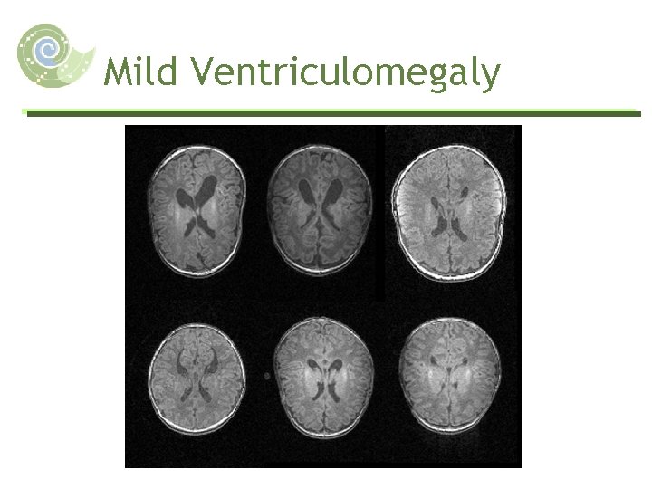 Mild Ventriculomegaly 