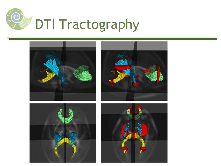 DTI Tractography 