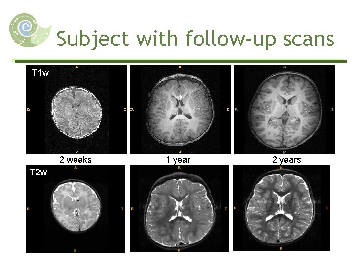Subject with follow-up scans T 1 w 2 weeks T 2 w 1 year