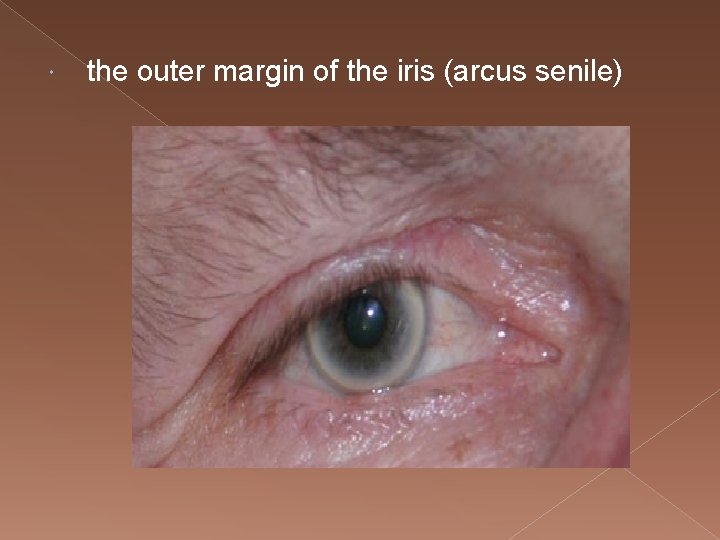  the outer margin of the iris (arcus senile) 