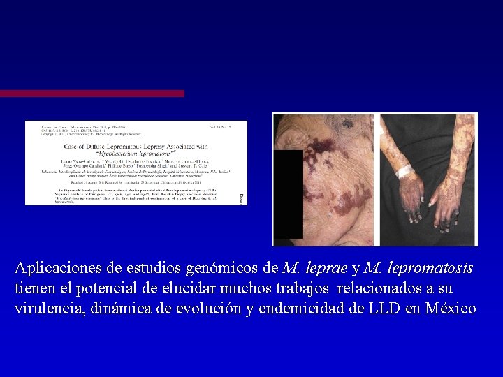 Aplicaciones de estudios genómicos de M. leprae y M. lepromatosis tienen el potencial de