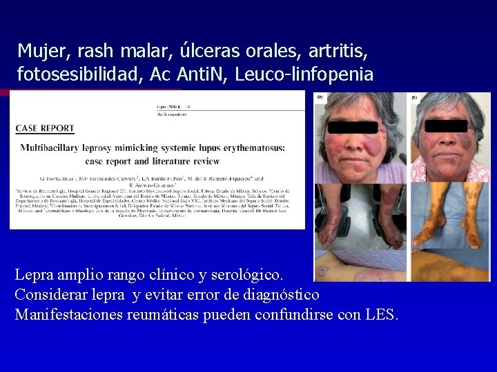 Mujer, rash malar, úlceras orales, artritis, fotosesibilidad, Ac Anti. N, Leuco-linfopenia Lepra amplio rango