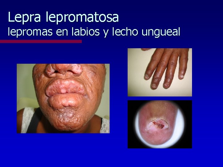 Lepra lepromatosa lepromas en labios y lecho ungueal 