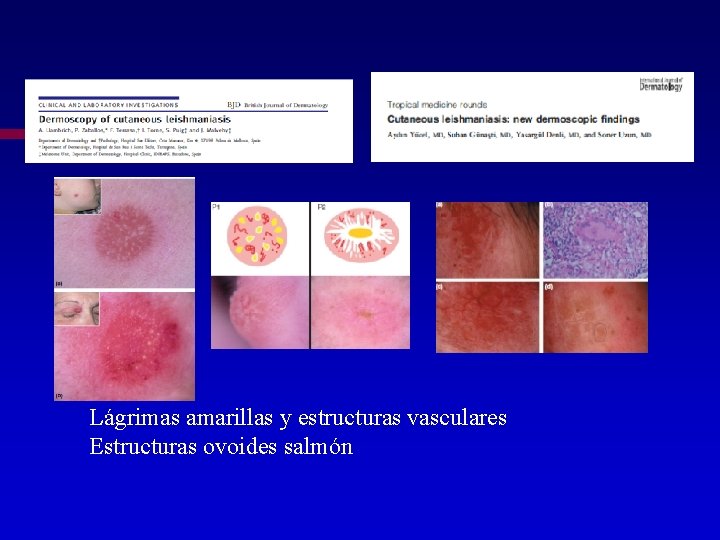 Lágrimas amarillas y estructuras vasculares Estructuras ovoides salmón 