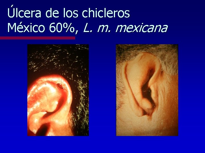 Úlcera de los chicleros México 60%, L. m. mexicana 