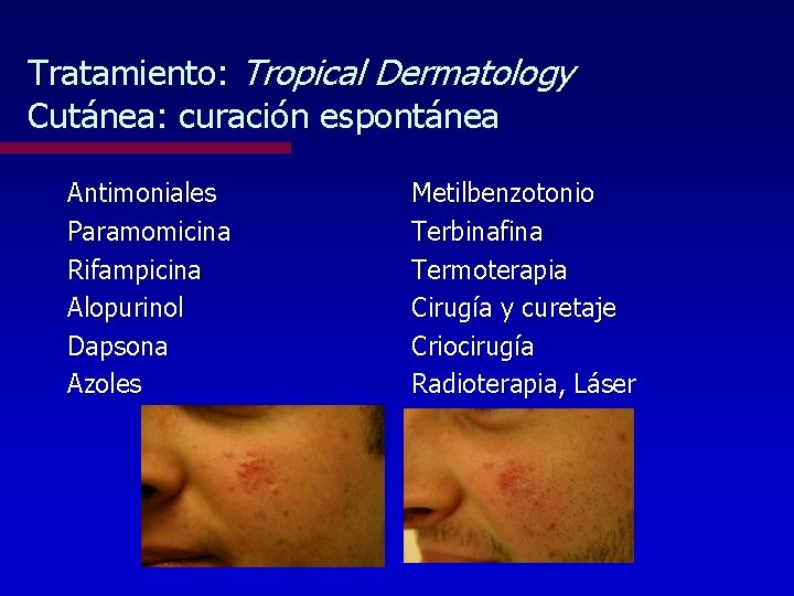 Tratamiento: Tropical Dermatology Cutánea: curación espontánea Antimoniales Paramomicina Rifampicina Alopurinol Dapsona Azoles Metilbenzotonio Terbinafina