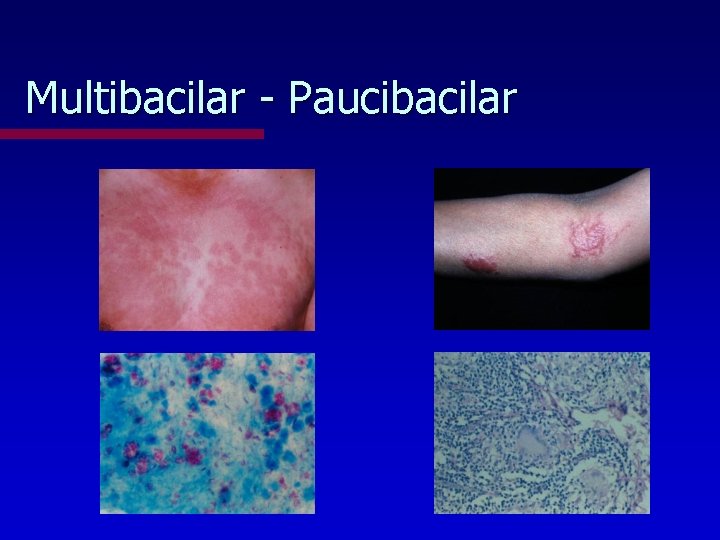 Multibacilar - Paucibacilar 