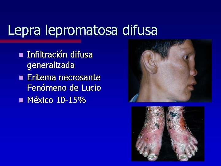 Lepra lepromatosa difusa Infiltración difusa generalizada n Eritema necrosante Fenómeno de Lucio n México