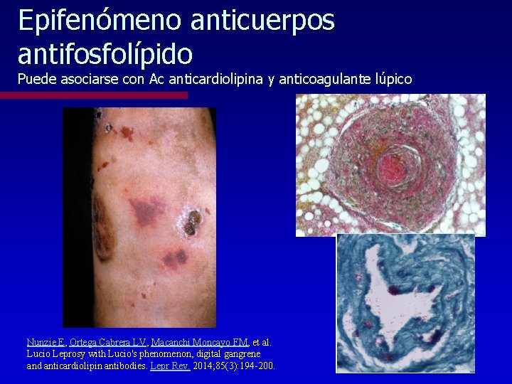 Epifenómeno anticuerpos antifosfolípido Puede asociarse con Ac anticardiolipina y anticoagulante lúpico Nunzie E, Ortega