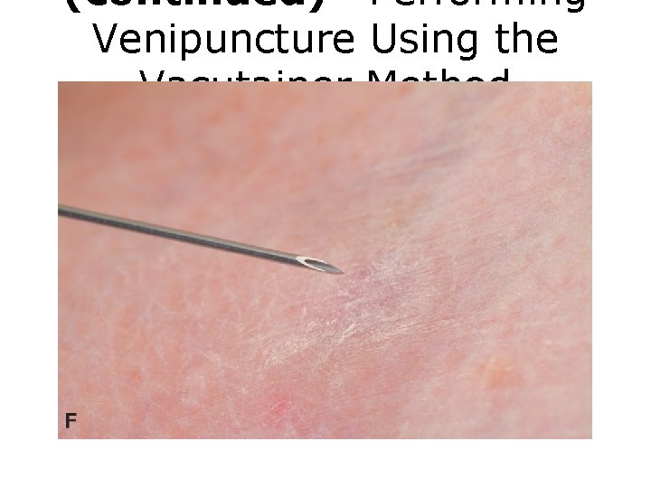 (continued) Performing Venipuncture Using the Vacutainer Method FIGURE F Venipuncture procedure. 