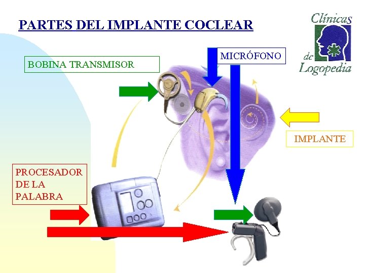 PARTES DEL IMPLANTE COCLEAR BOBINA TRANSMISOR MICRÓFONO IMPLANTE PROCESADOR DE LA PALABRA 