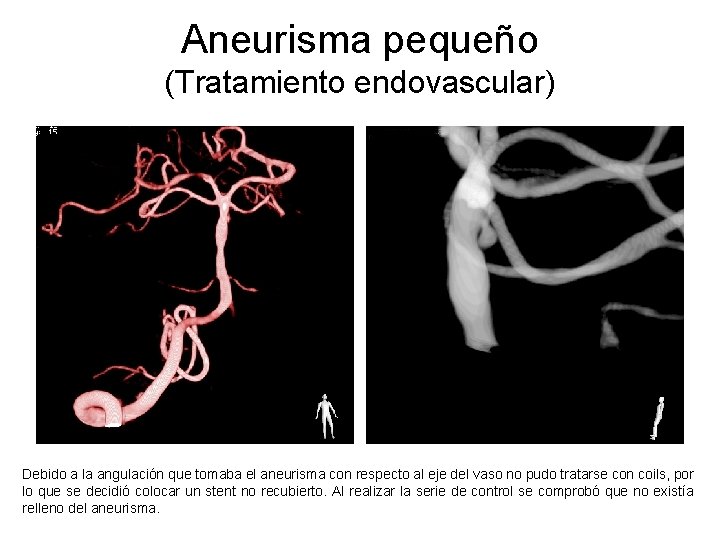 Aneurisma pequeño (Tratamiento endovascular) Debido a la angulación que tomaba el aneurisma con respecto