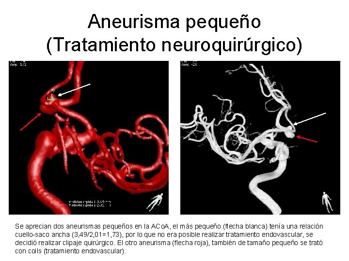 Aneurisma pequeño (Tratamiento neuroquirúrgico) Se aprecian dos aneurismas pequeños en la ACo. A, el