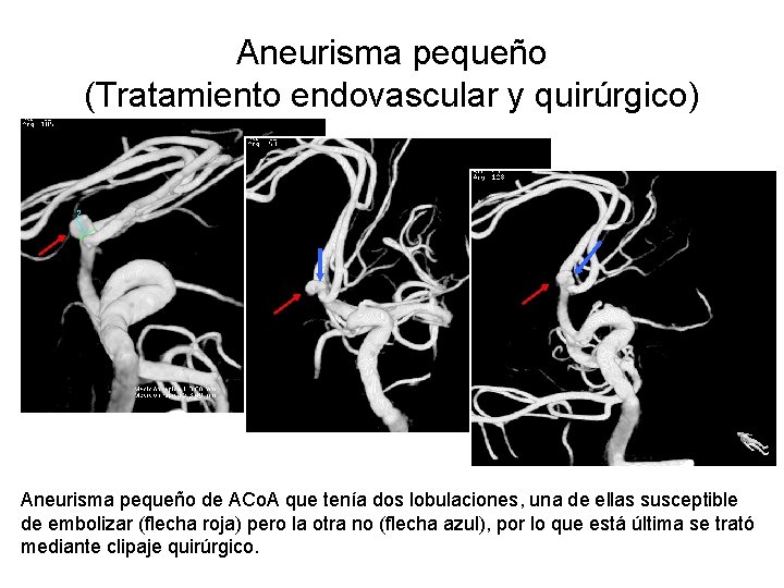 Aneurisma pequeño (Tratamiento endovascular y quirúrgico) Aneurisma pequeño de ACo. A que tenía dos