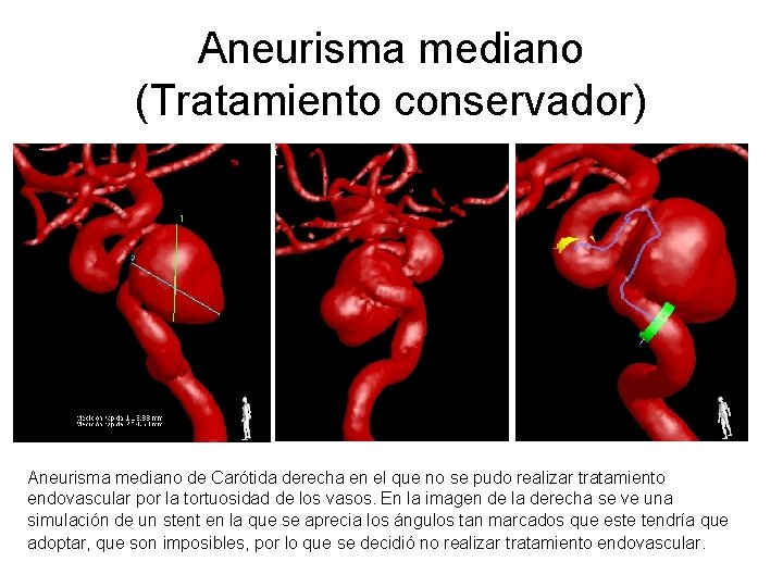 Aneurisma mediano (Tratamiento conservador) Aneurisma mediano de Carótida derecha en el que no se