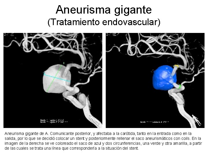 Aneurisma gigante (Tratamiento endovascular) Aneurisma gigante de A. Comunicante posterior, y afectaba a la