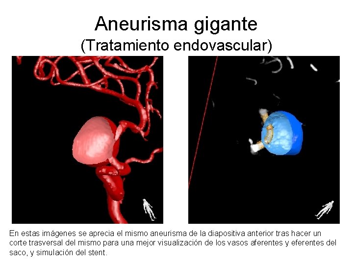 Aneurisma gigante (Tratamiento endovascular) En estas imágenes se aprecia el mismo aneurisma de la