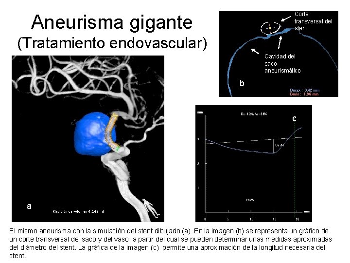 Corte transversal del stent Aneurisma gigante (Tratamiento endovascular) Cavidad del saco aneurismático b c