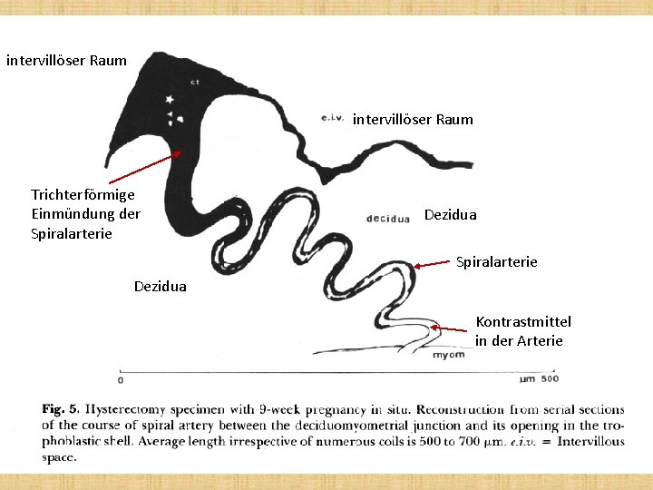 intervillöser Raum Trichterförmige Einmündung der Spiralarterie Dezidua Kontrastmittel in der Arterie 