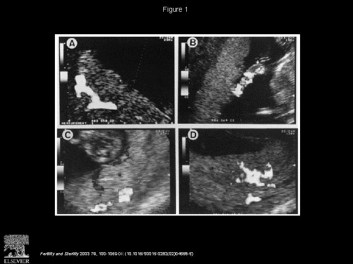 Figure 1 Fertility and Sterility 2003 79, 100 -106 DOI: (10. 1016/S 0015 -0282(02)04568