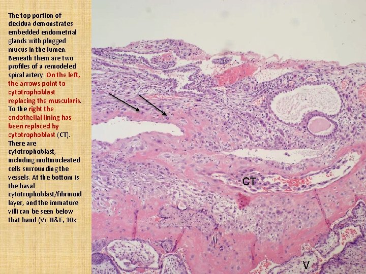 The top portion of decidua demonstrates embedded endometrial glands with plugged mucus in the