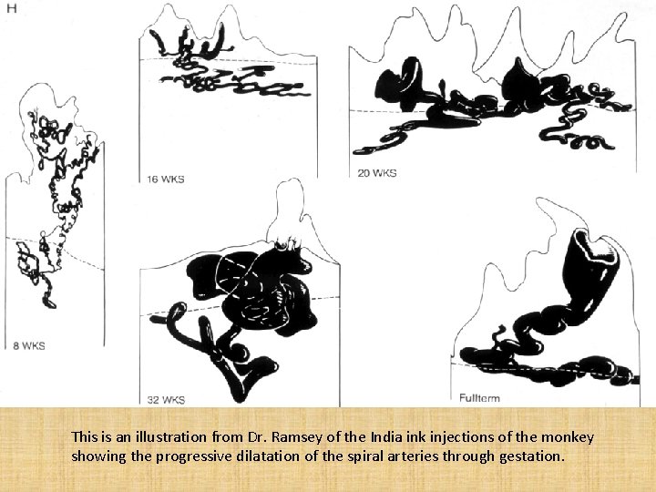 This is an illustration from Dr. Ramsey of the India ink injections of the