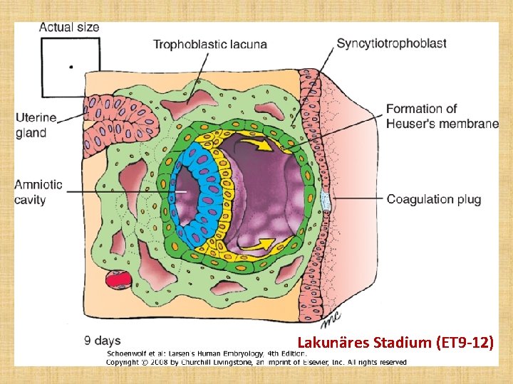 Lakunäres Stadium (ET 9 -12) 