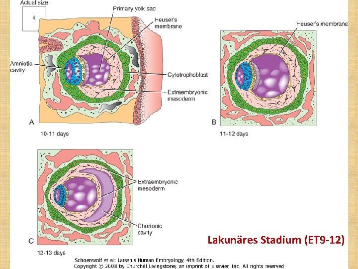 Lakunäres Stadium (ET 9 -12) 