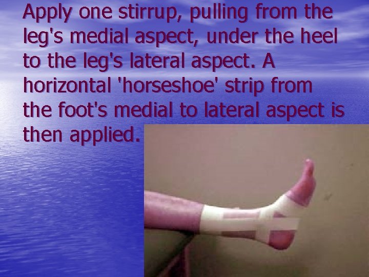 Apply one stirrup, pulling from the leg's medial aspect, under the heel to the