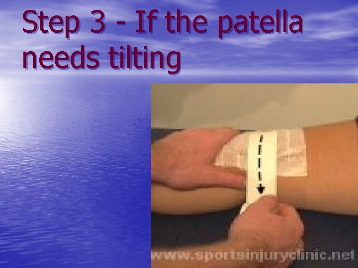 Step 3 - If the patella needs tilting 