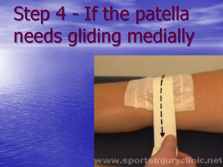 Step 4 - If the patella needs gliding medially 