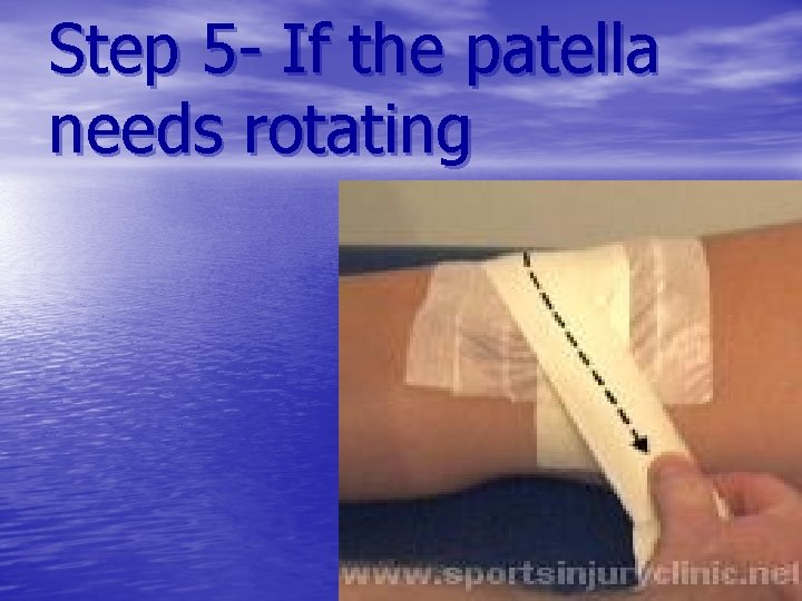 Step 5 - If the patella needs rotating 